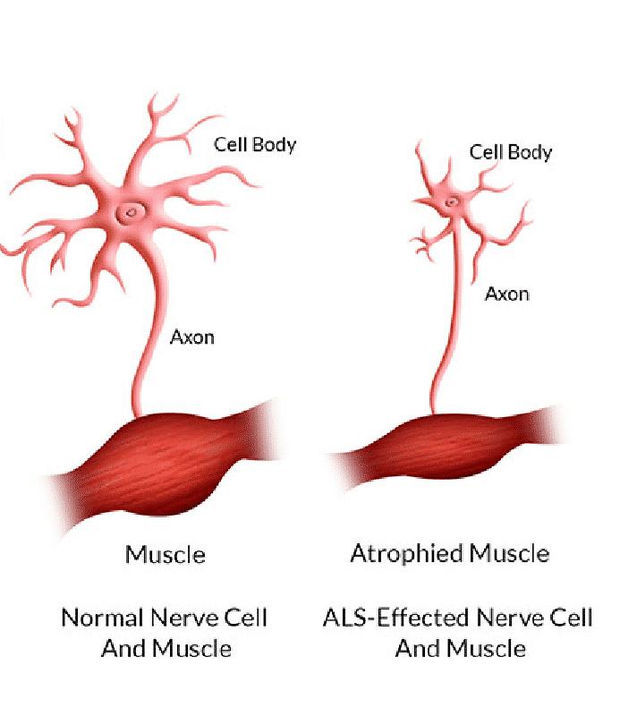 ALS-Effected-Nerve-Cell-And-Muscle