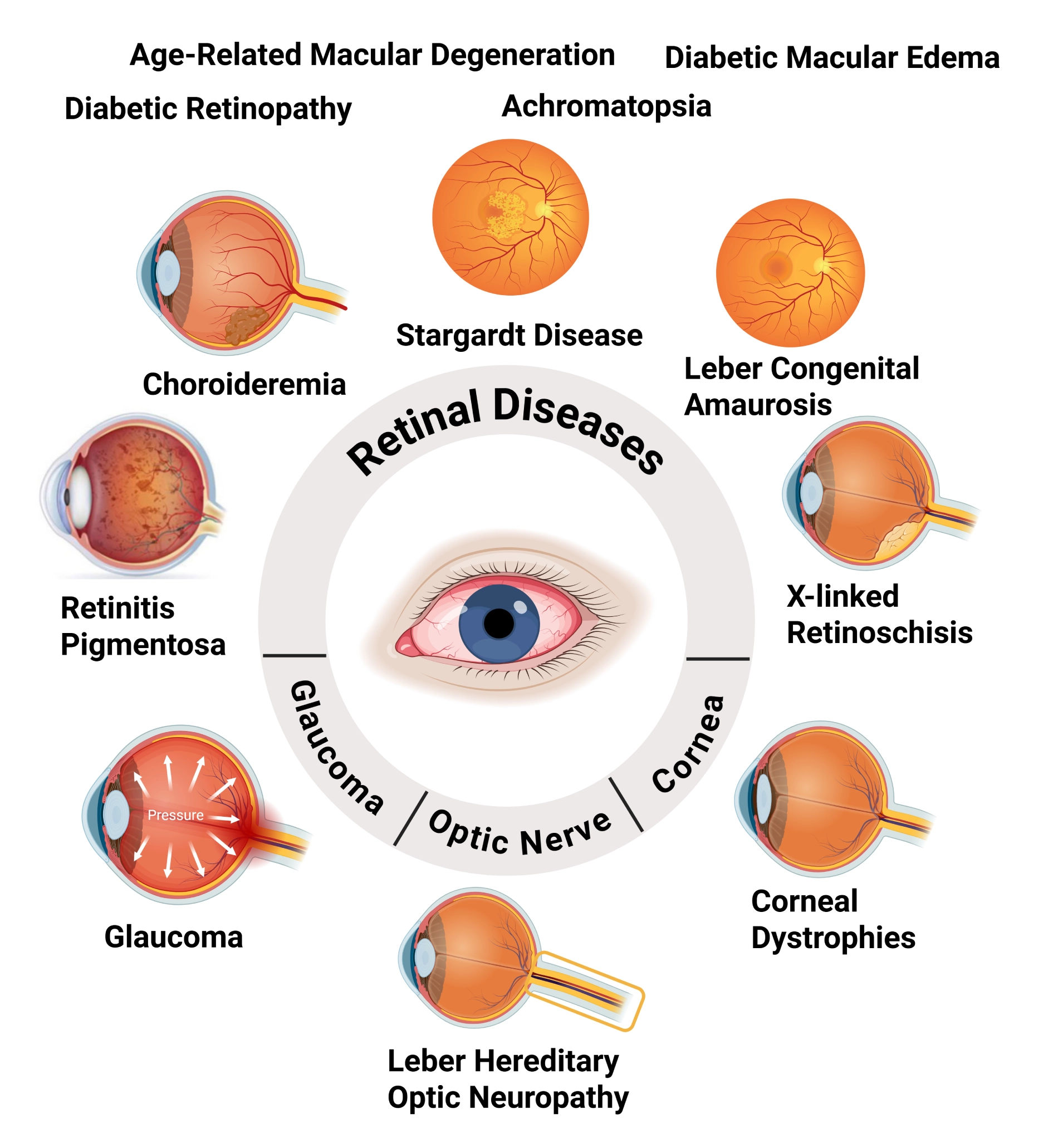 AAV therapy targets a spectrum of ocular diseases